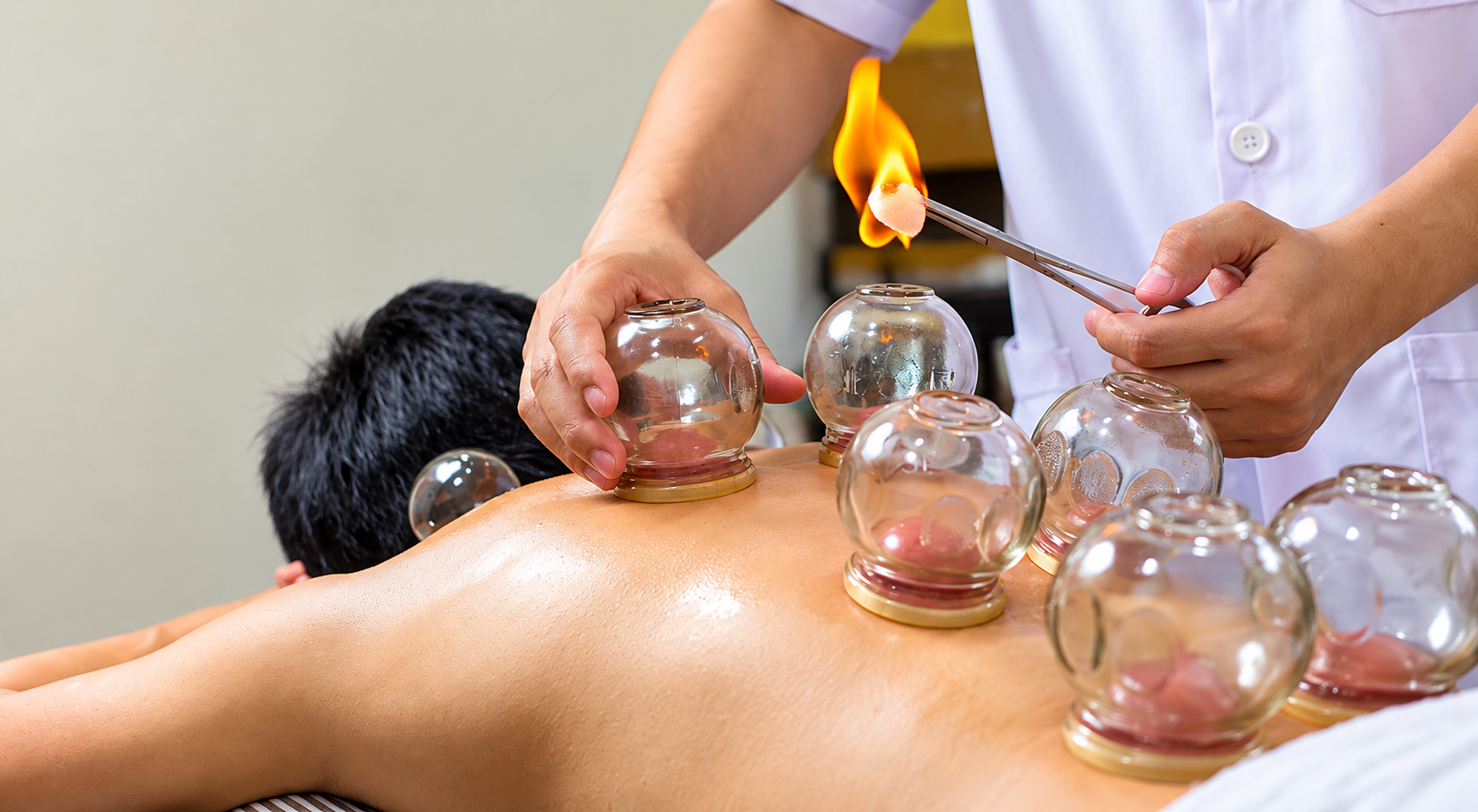 Cupping Therapy Treatment